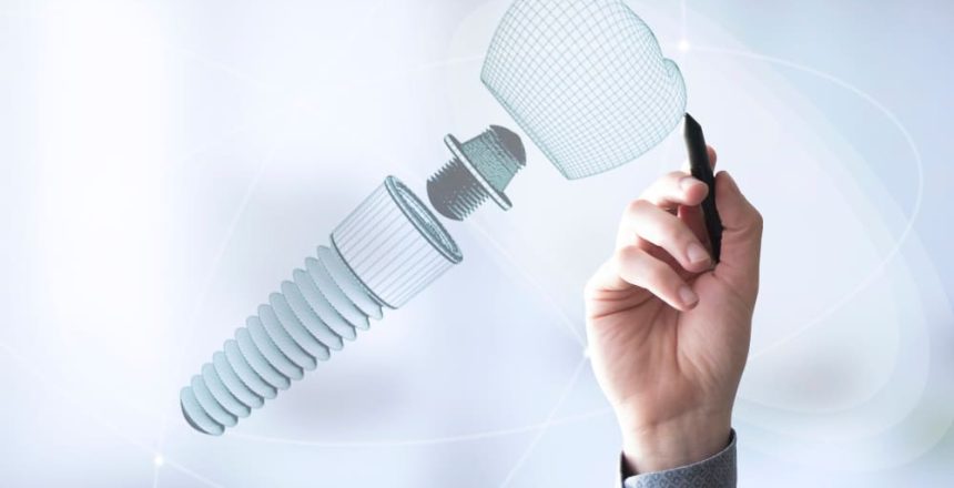 Implantes dentales de última generación